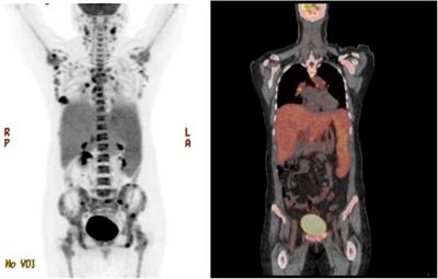 Case report: An exceptional responder of low-dose continuous 5-FU in a patient with de-novo stage IV triple-negative breast cancer with liver and bone marrow failure